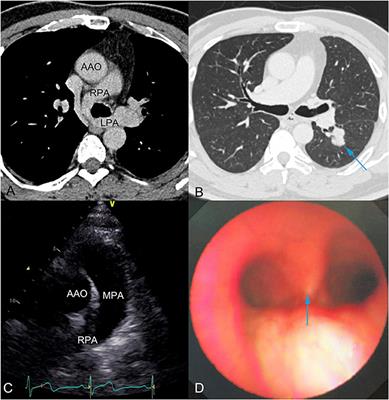 Lung Cancer in a Patient With Pulmonary Artery Sling: A Case Report